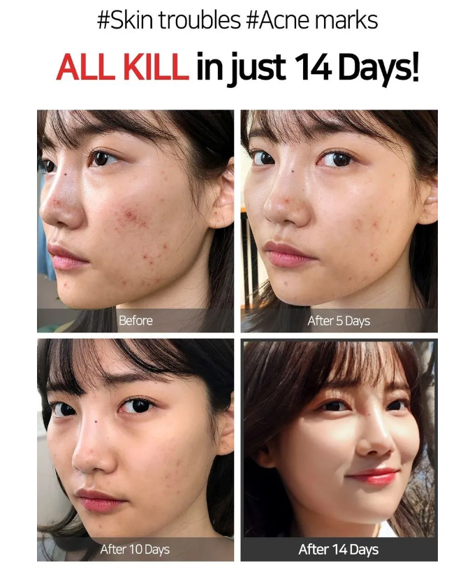 SOMEBYMI AHA-BHA-PHA Acne Super Miracle Spot All Kill Cream 30ml